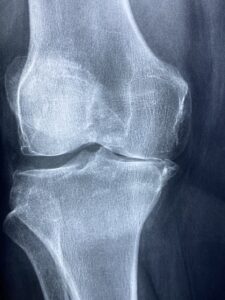 Arthrose et réflexologie